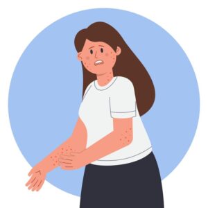 Scopri di più sull'articolo ORTICARIA