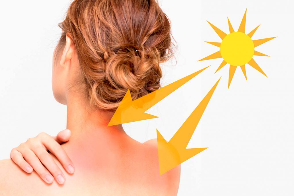 Scopri di più sull'articolo SCOTTATURE SOLARI: cura e prevenzione