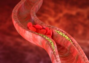 Scopri di più sull'articolo Vitamina D3 e K2 rallentano la progressione della calcificazione coronarica
