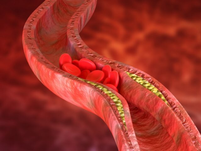 Vitamina D3 e K2 rallentano la progressione della calcificazione coronarica